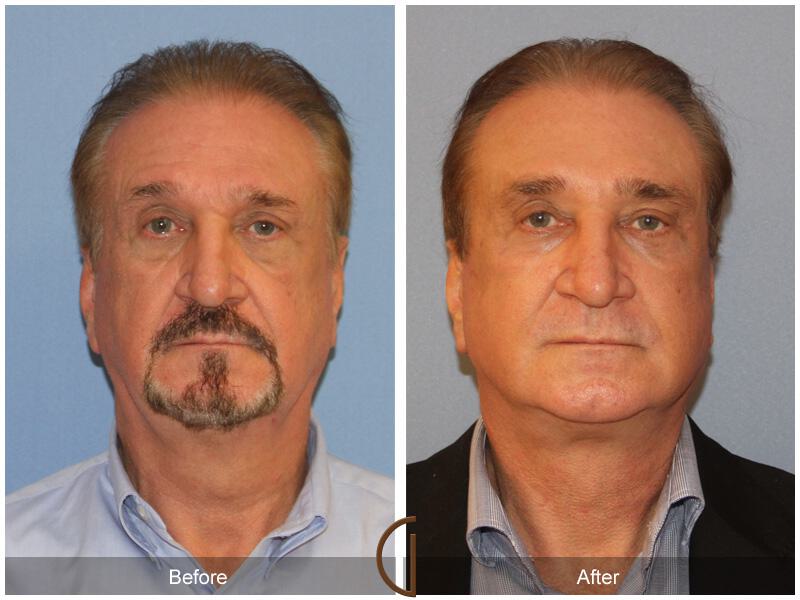 Facelift Male Before & After Photo