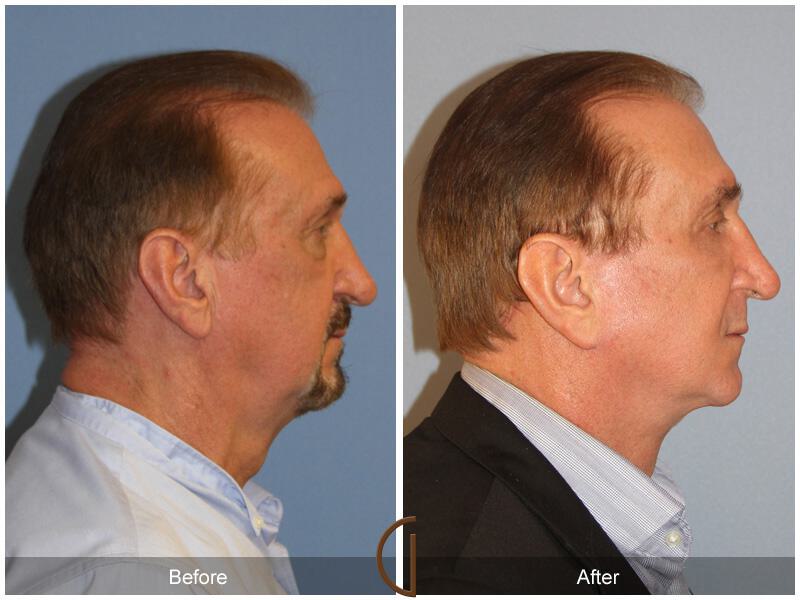 Facelift Male Before & After Photo