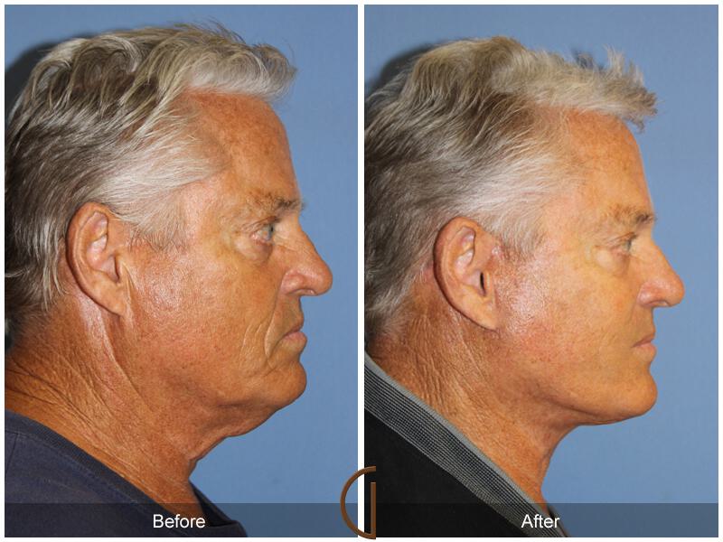 Facelift Male Before & After Photo