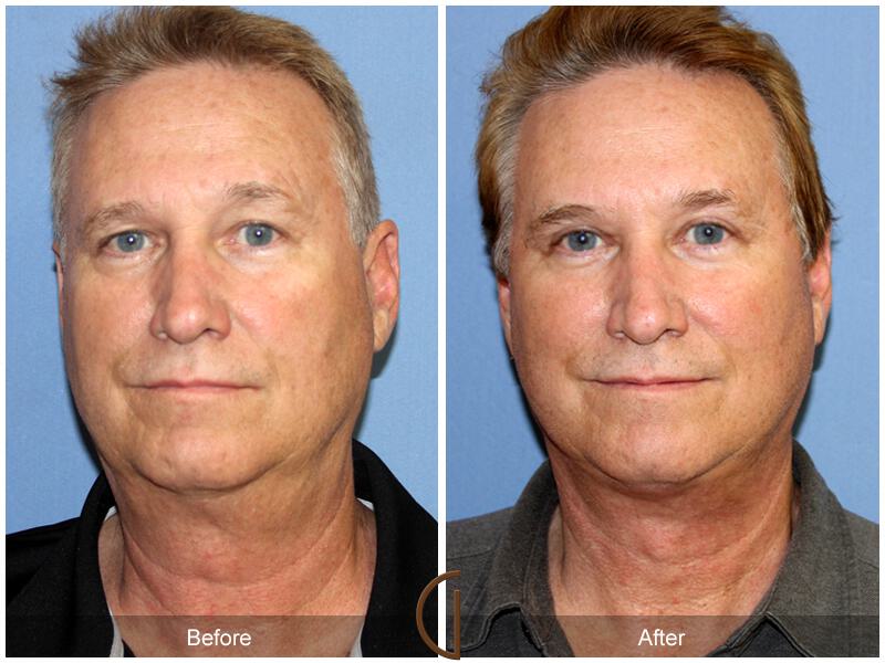 Facelift Male Before & After Photo