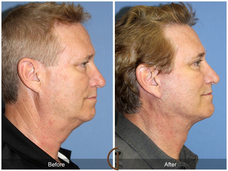 Facelift Male Before & After Photo