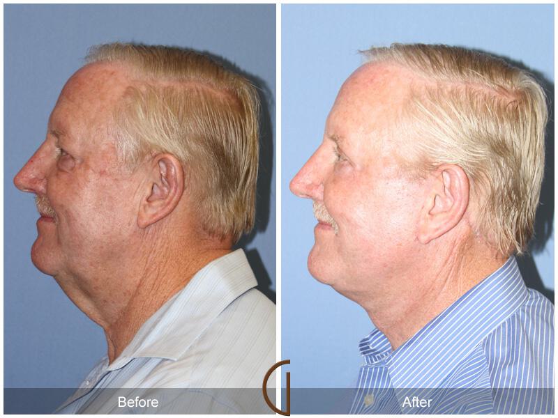 Facelift Male Before & After Photo