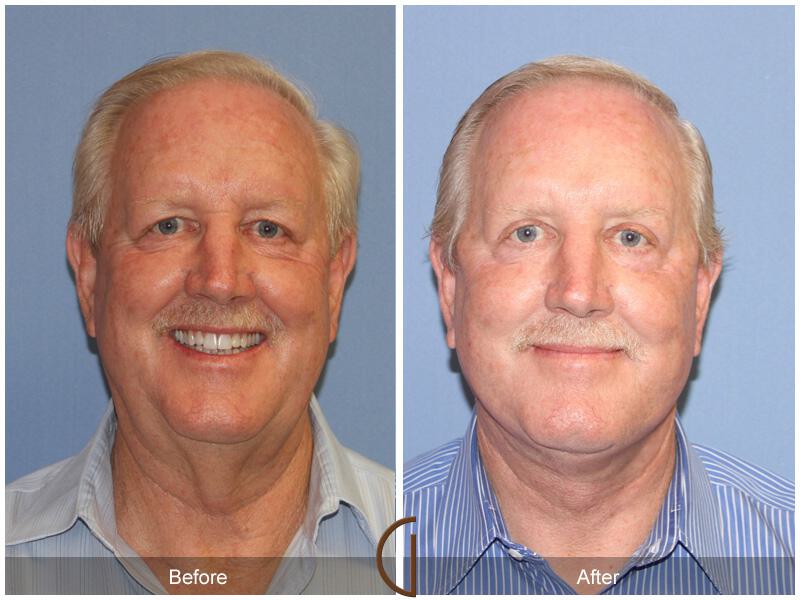 Facelift Male Before & After Photo