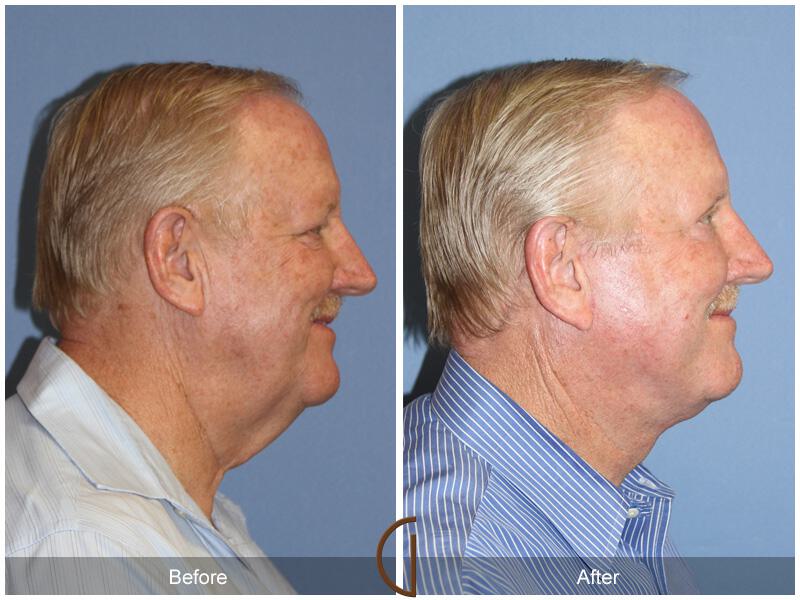 Facelift Male Before & After Photo