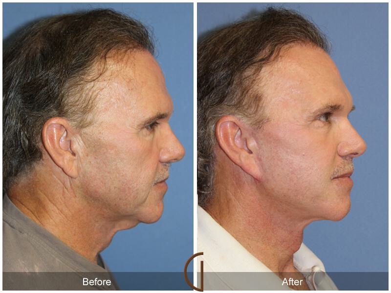 Facelift Male Before & After Photo