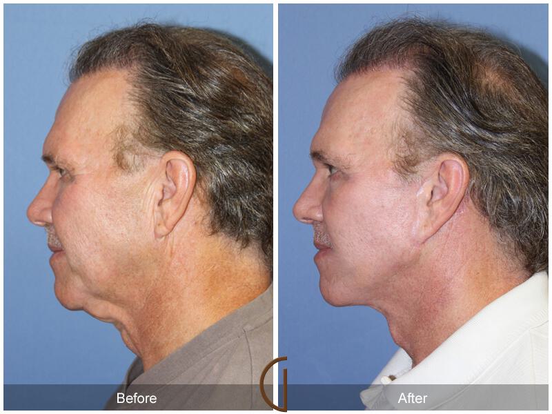 Facelift Male Before & After Photo