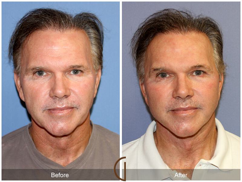 Facelift Male Before & After Photo