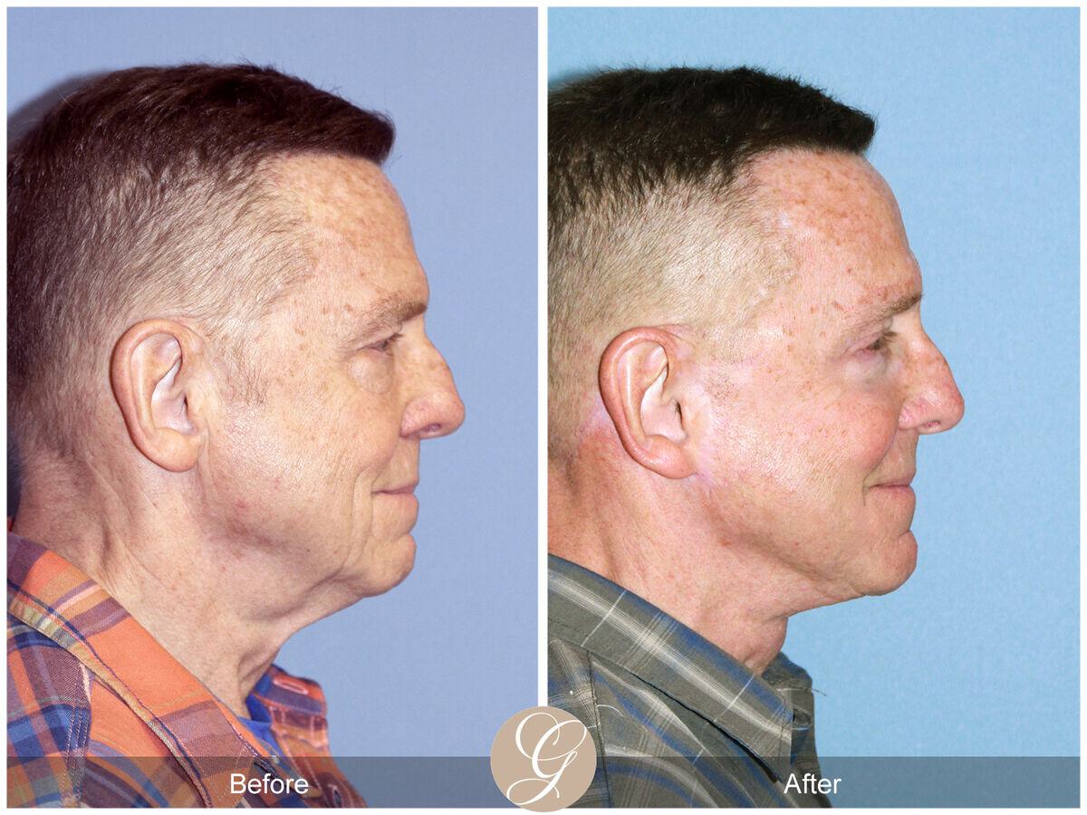 Facelift Male Before & After Photo