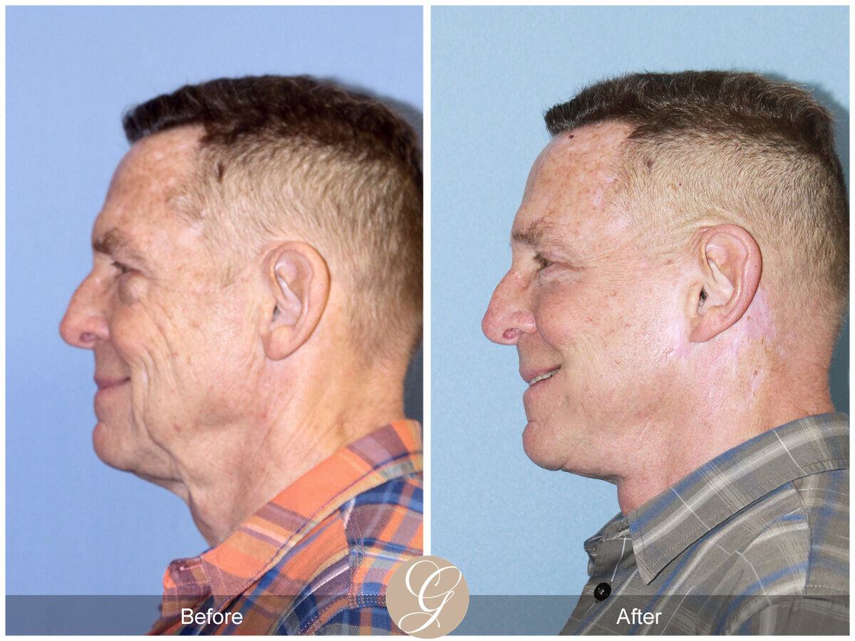 Facelift Male Before & After Photo