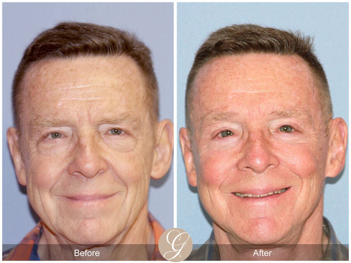 Facelift Male Before & After Photo