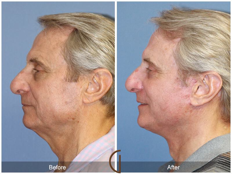 Facelift Male Before & After Photo