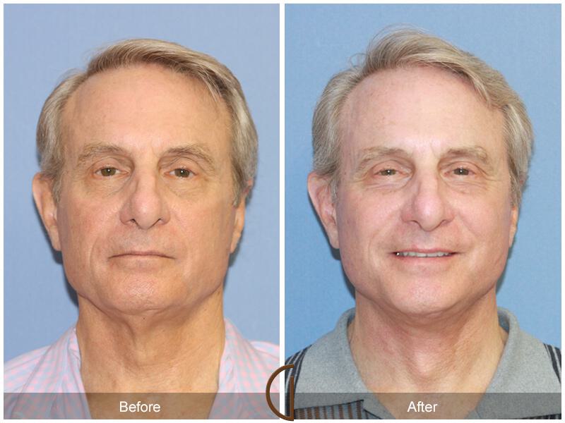 Facelift Male Before & After Photo