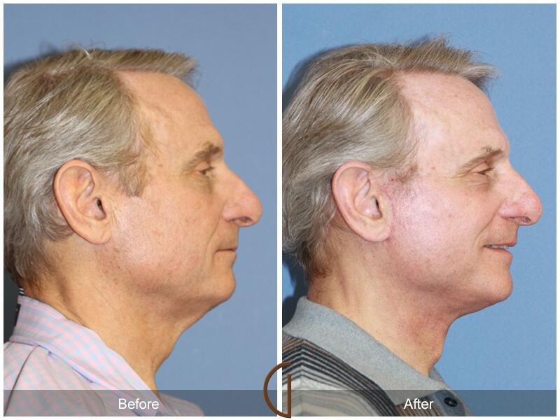 Facelift Male Before & After Photo