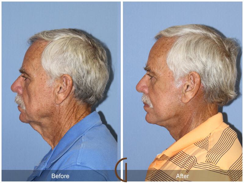 Facelift Male Before & After Photo