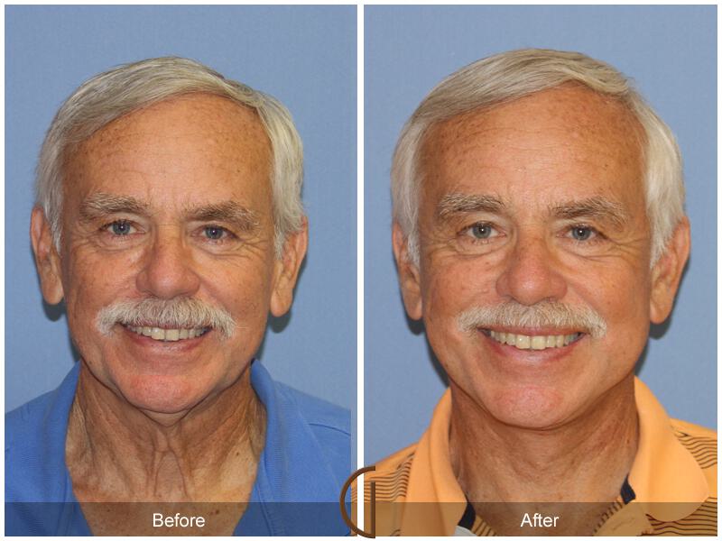 Facelift Male Before & After Photo