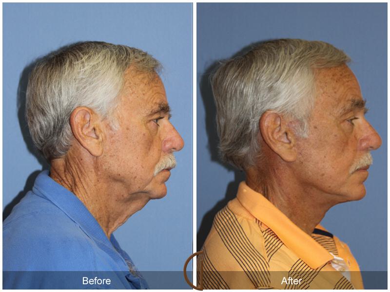 Facelift Male Before & After Photo