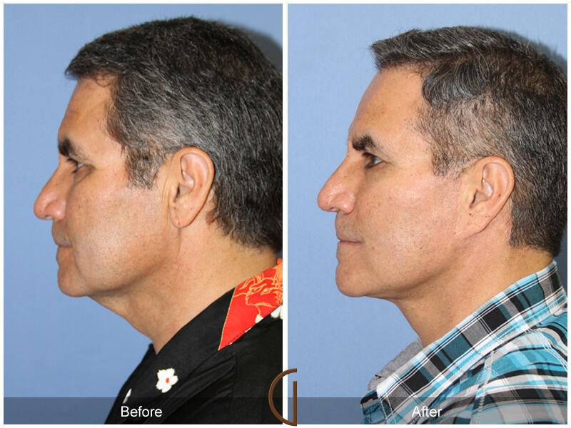 Facelift Male Before & After Photo