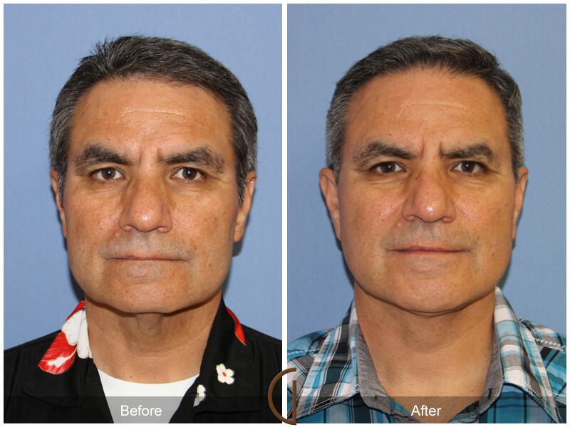 Facelift Male Before & After Photo