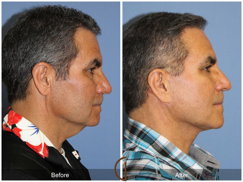 Facelift Male Before & After Photo