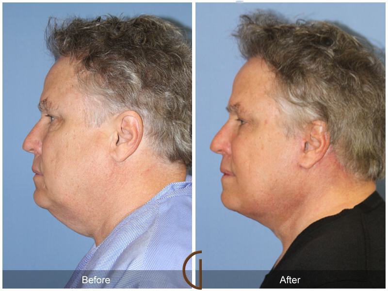 Facelift Male Before & After Photo