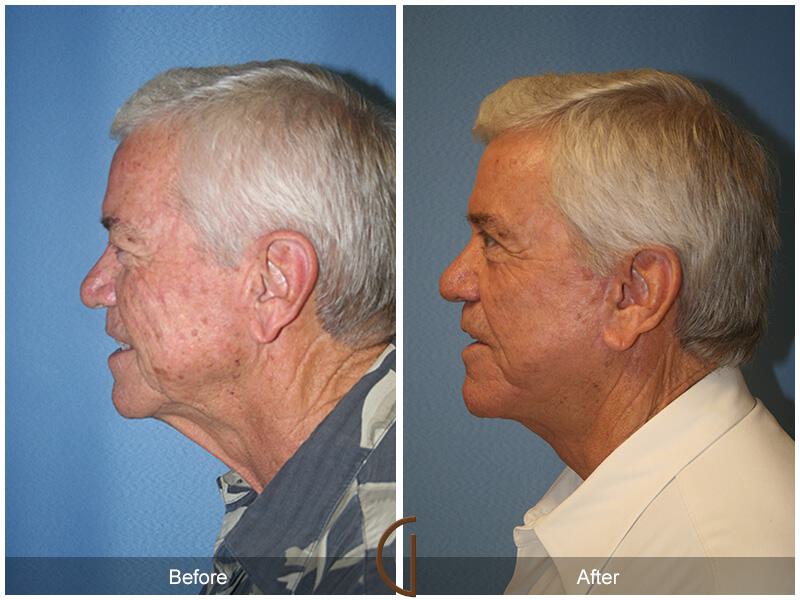 Facelift Male Before & After Photo