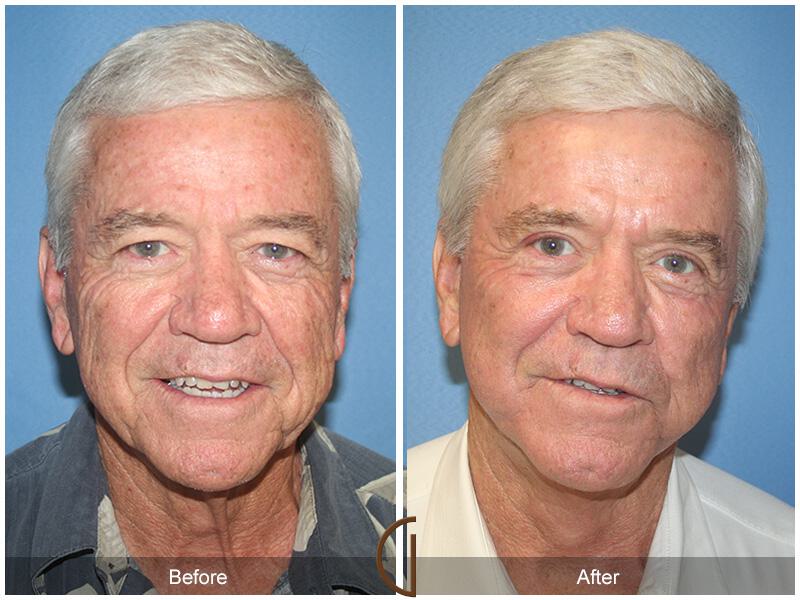 Facelift Male Before & After Photo