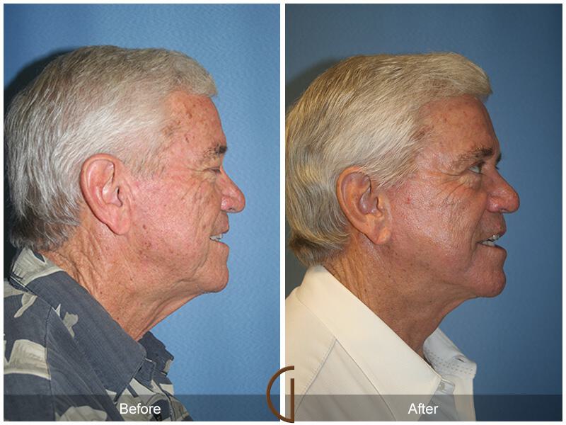 Facelift Male Before & After Photo