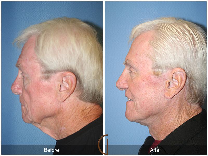 Facelift Male Before & After Photo