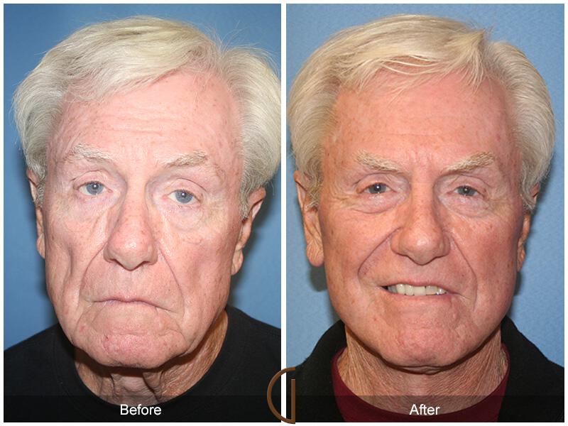 Facelift Male Before & After Photo