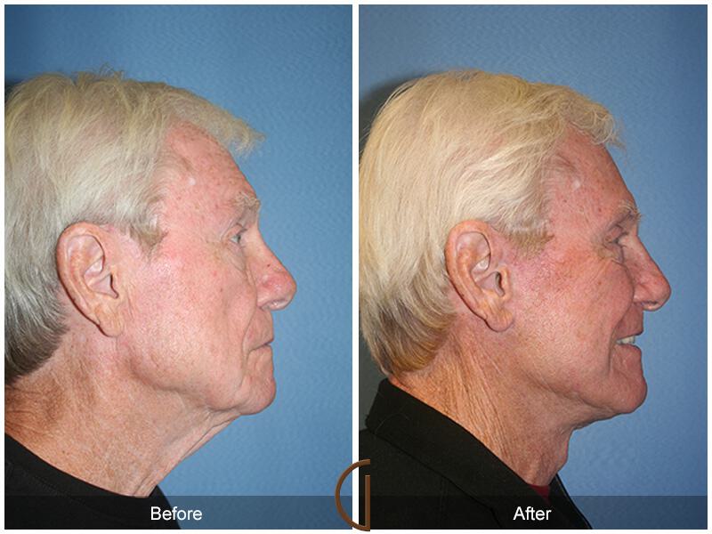 Facelift Male Before & After Photo