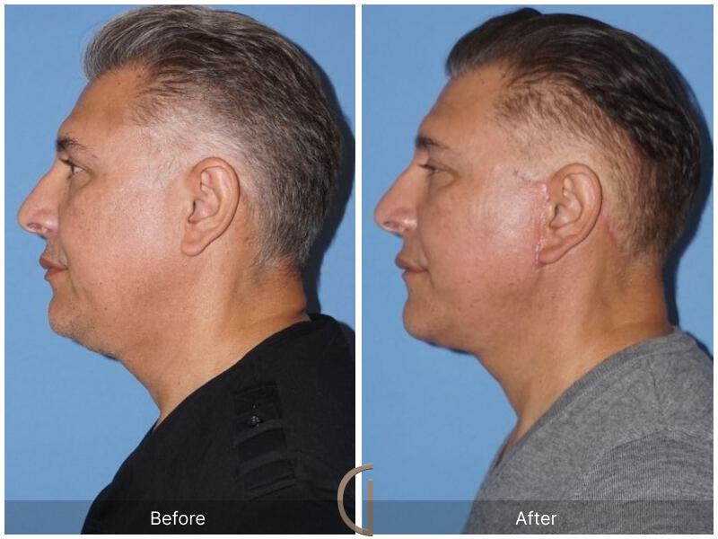 Facelift Male Before & After Photo