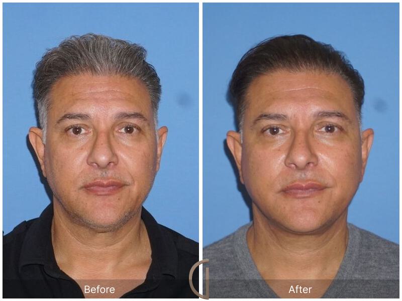 Facelift Male Before & After Photo