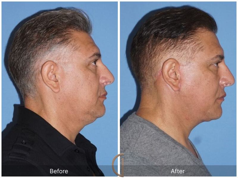 Facelift Male Before & After Photo