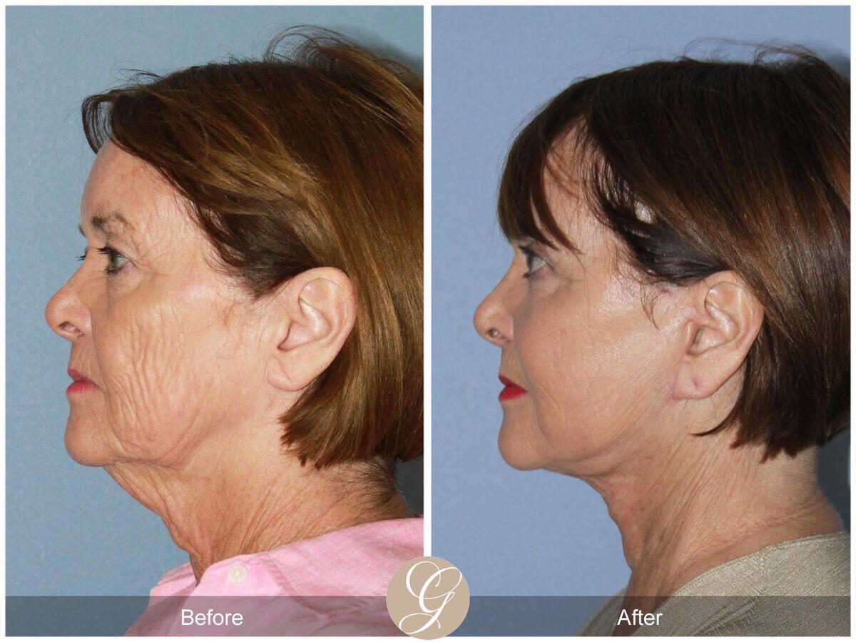 Facelift With Other Procedures Before & After Photo