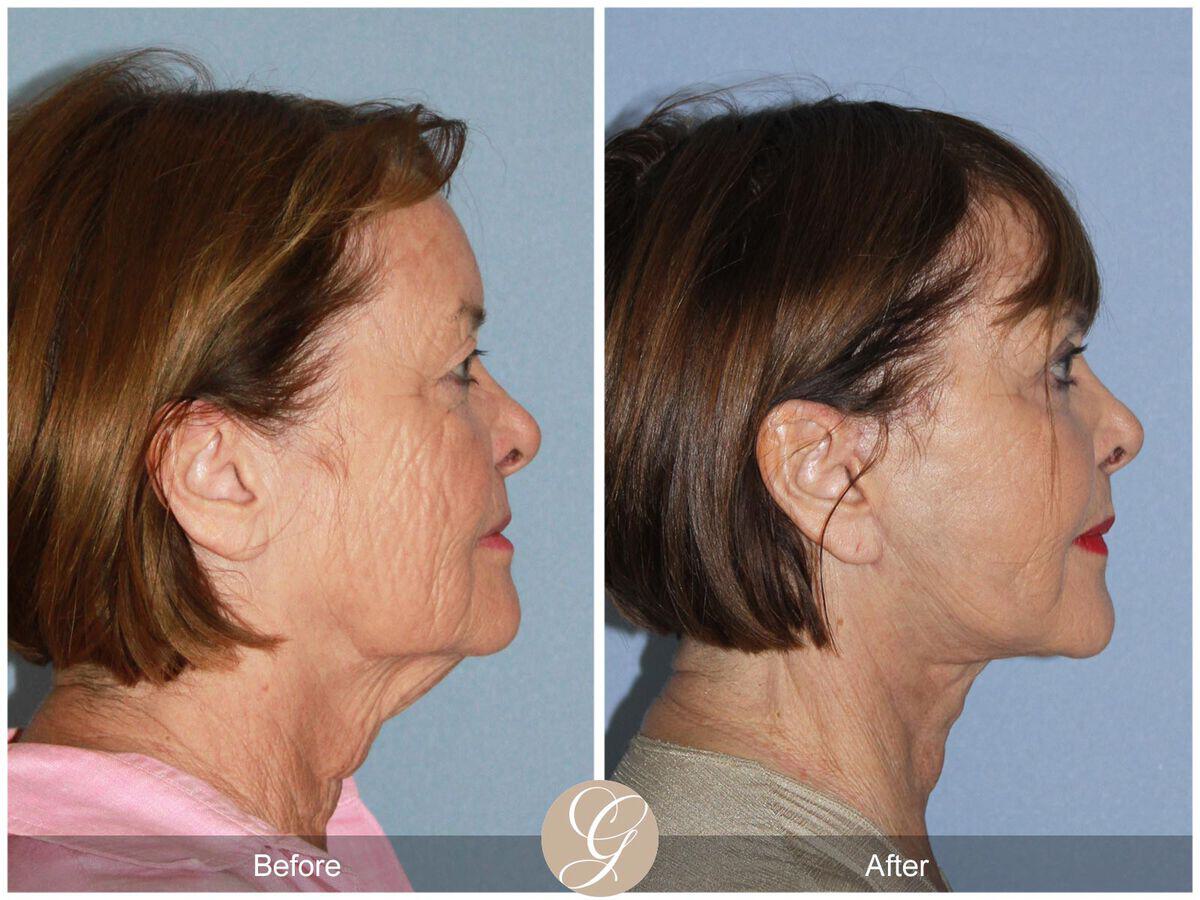 Facelift With Other Procedures Before & After Photo