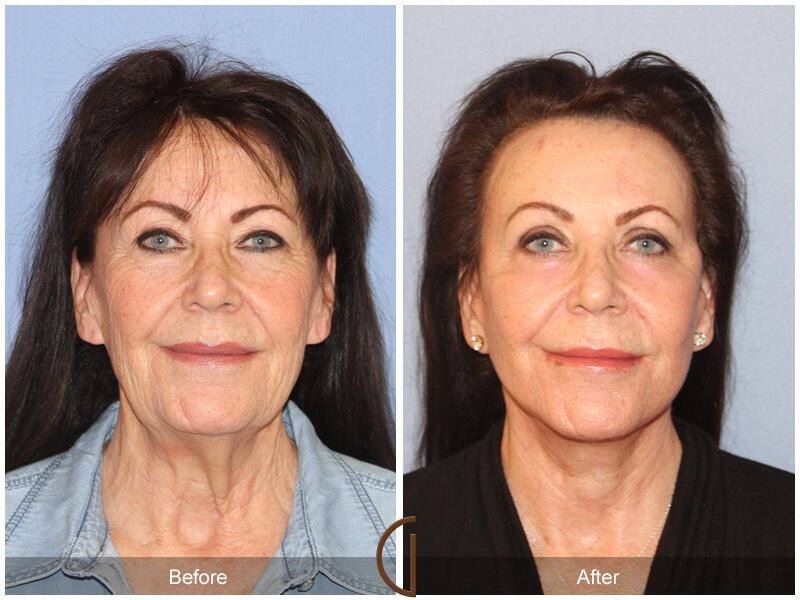 Facelift With Other Procedures Before & After Photo