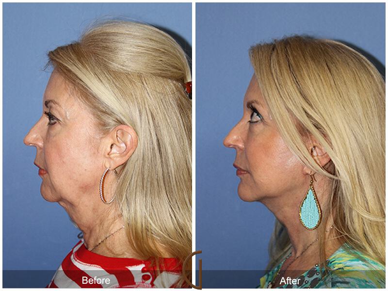 Facelift With Other Procedures Before & After Photo