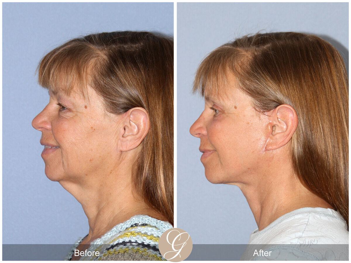 Facelift With Other Procedures Before & After Photo