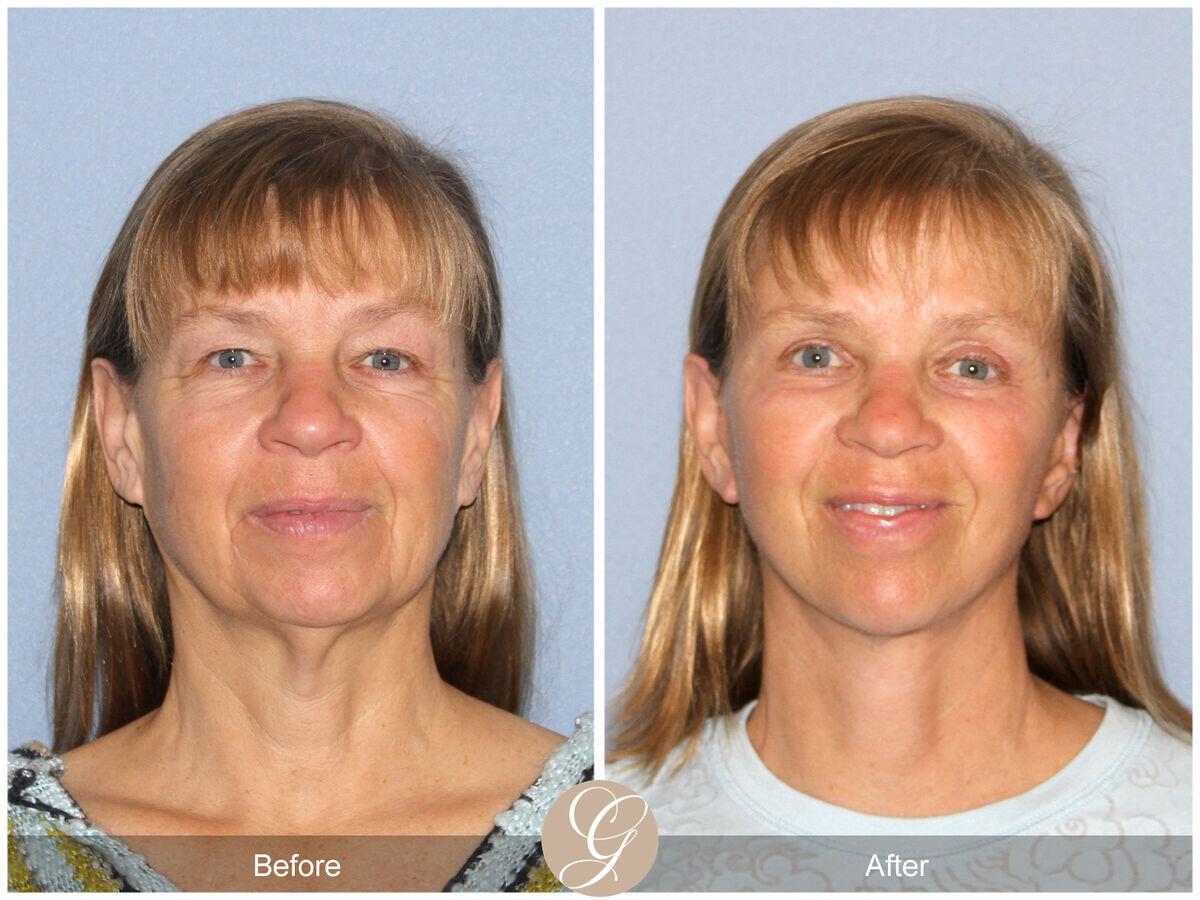 Facelift With Other Procedures Before & After Photo