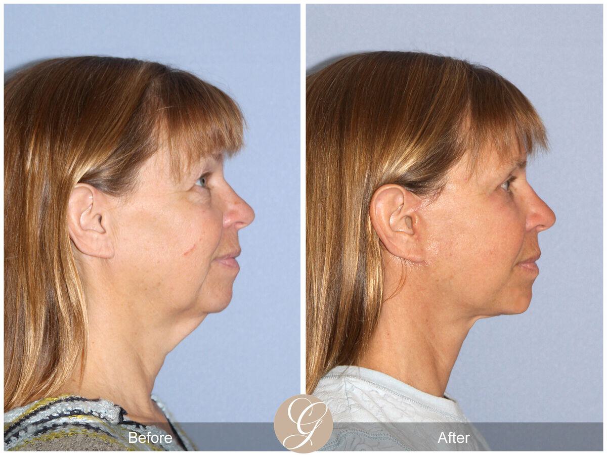 Facelift With Other Procedures Before & After Photo