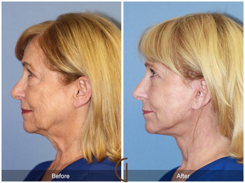 Facelift With Other Procedures Before & After Photo