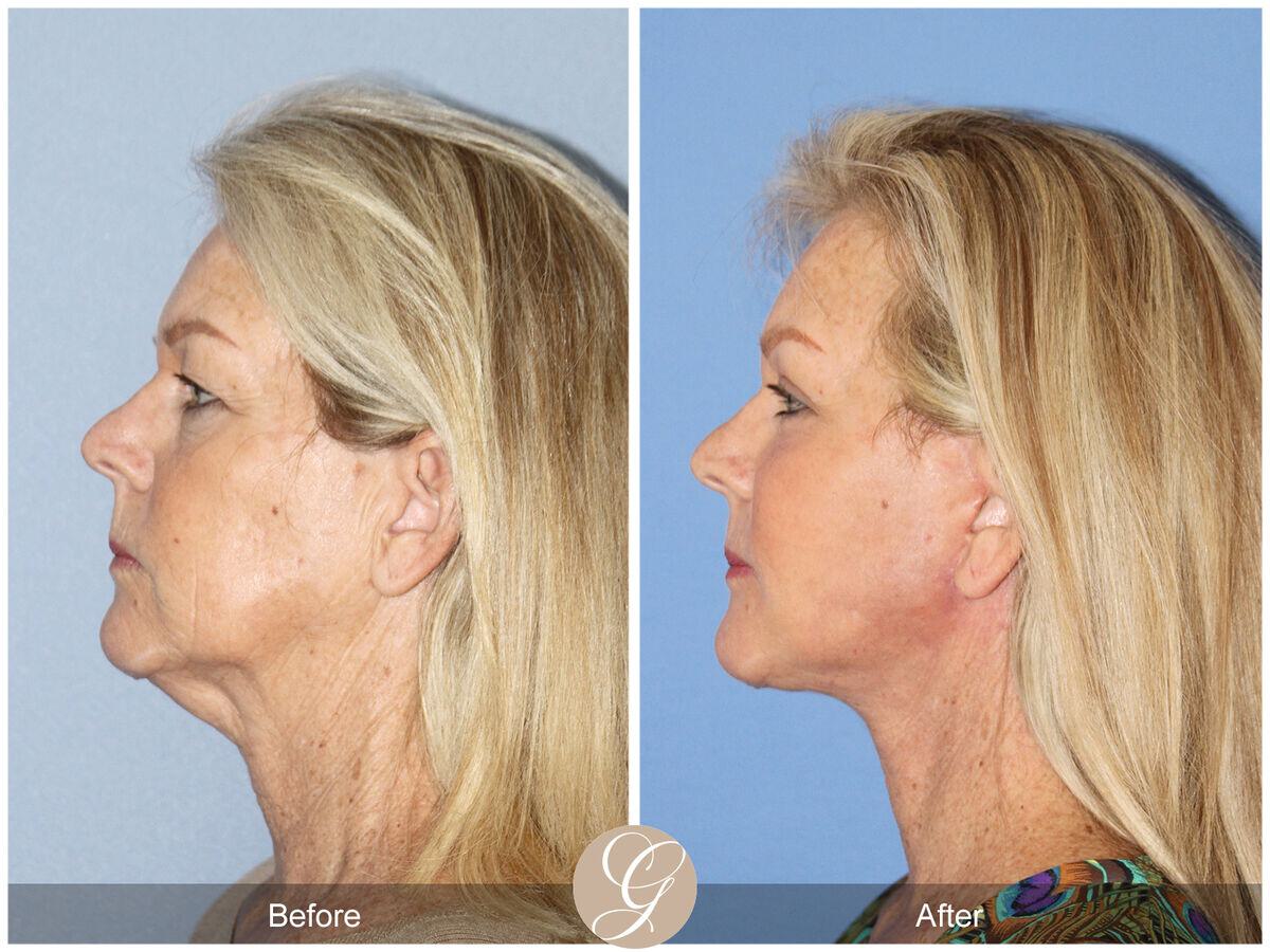 Facelift With Other Procedures Before & After Photo