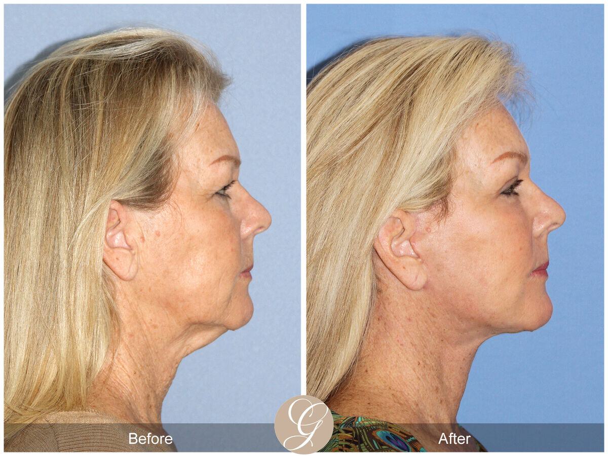 Facelift With Other Procedures Before & After Photo