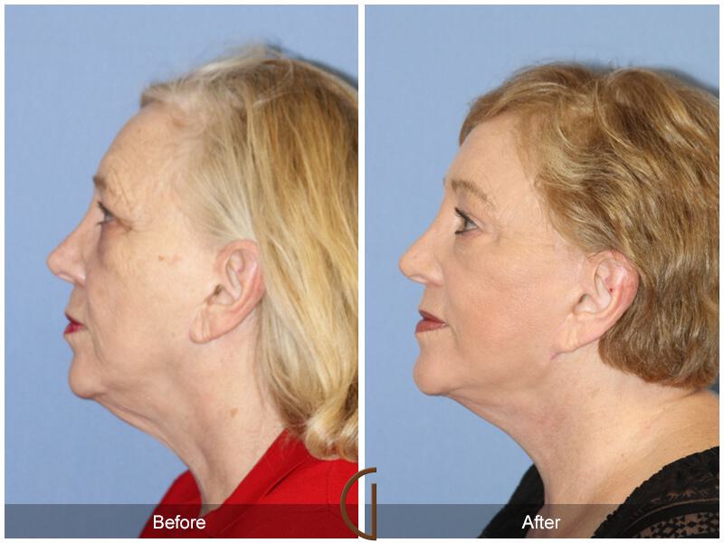 Facelift With Other Procedures Before & After Photo