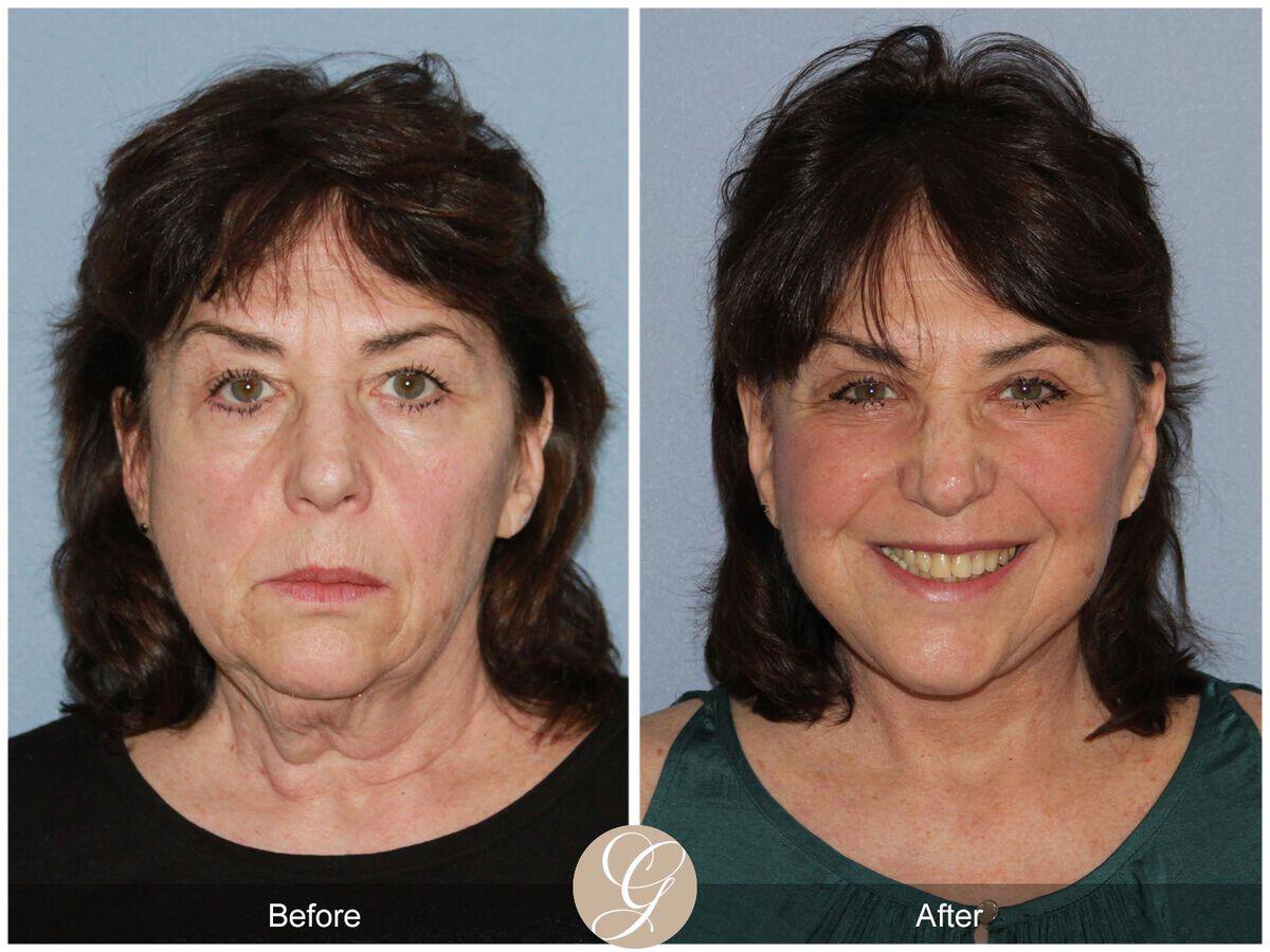 Facelift With Other Procedures Before & After Photo