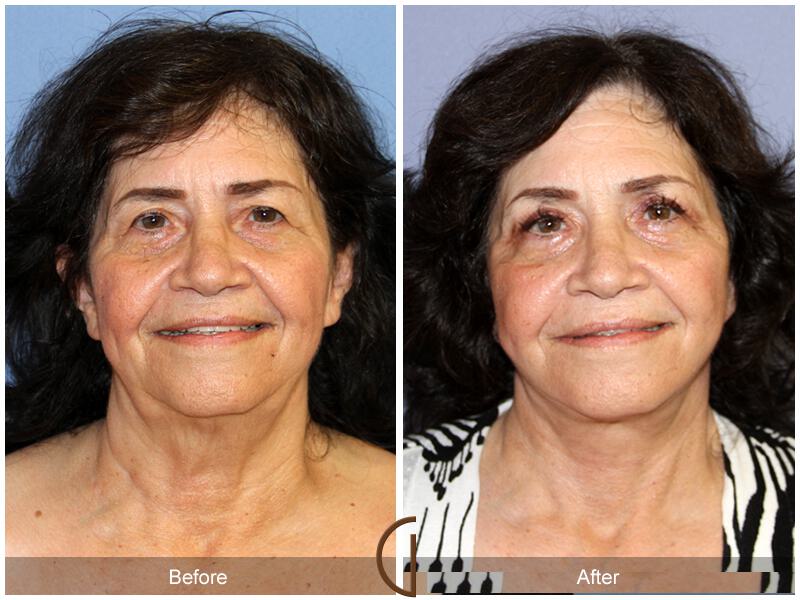 Facelift With Other Procedures Before & After Photo