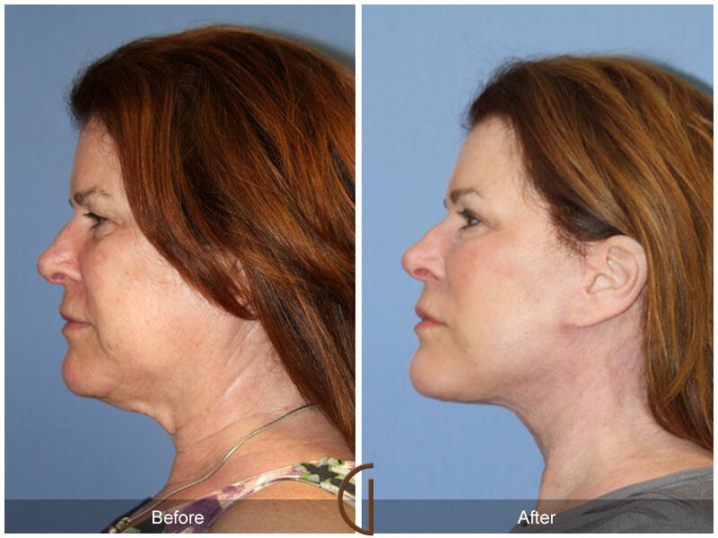 Facelift With Other Procedures Before & After Photo