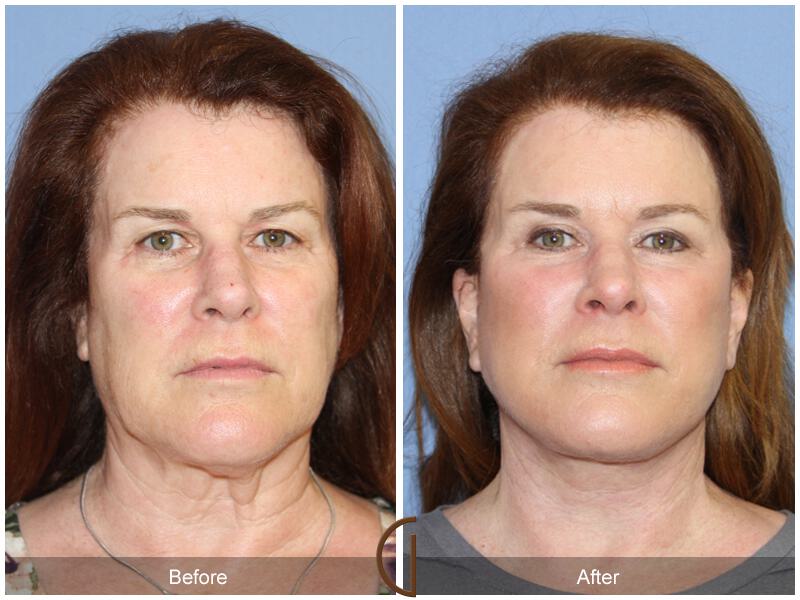 Facelift With Other Procedures Before & After Photo