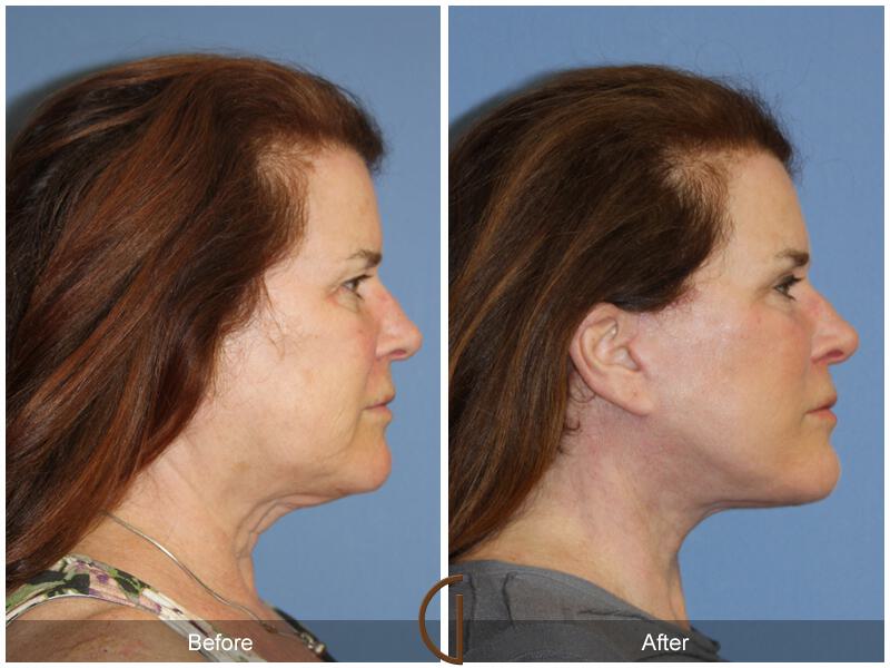 Facelift With Other Procedures Before & After Photo