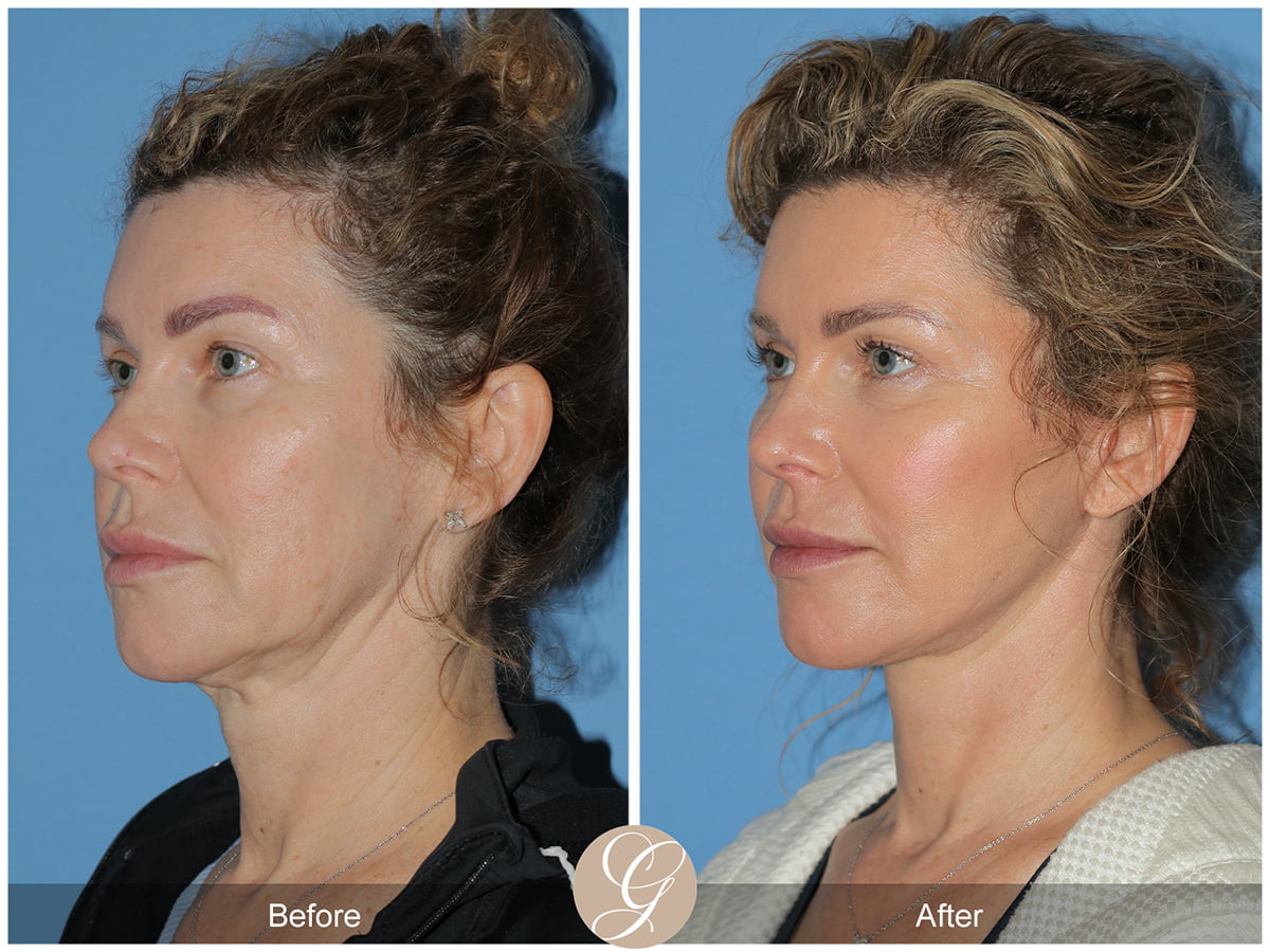 Lower Facelift Before & After Photo